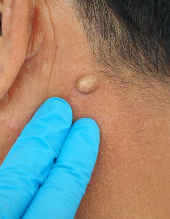 Cyst Treatment & Removal at Preferred Dermatology