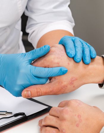 Eczema Treatment at Preferred Dermatology