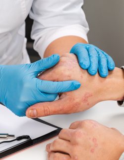 Eczema Treatment at Preferred Dermatology