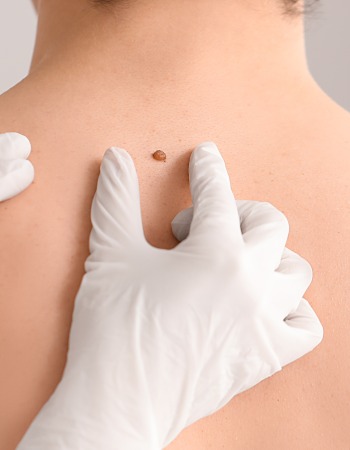 Mole Evaluation & Removal at Preferred Dermatology