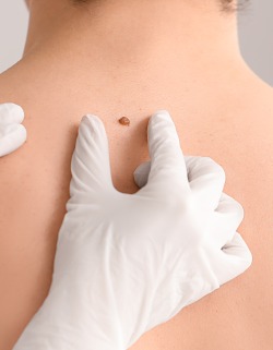 Mole Evaluation & Removal at Preferred Dermatology