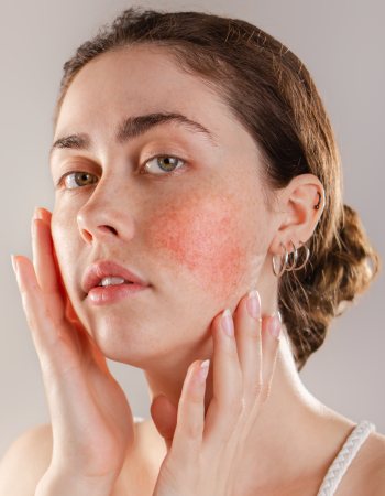 Rosacea Treatment at Preferred Dermatology