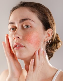 Rosacea Treatment at Preferred Dermatology