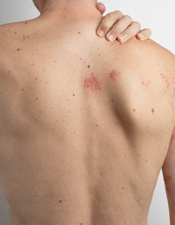Shingles Treatment at Preferred Dermatology