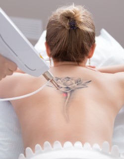 Laser Tattoo Removal at Preferred Dermatology