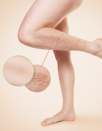 Vein Treatments at Preferred Dermatology