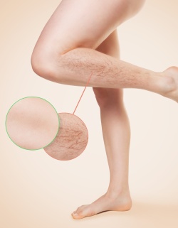 Vein Treatments at Preferred Dermatology