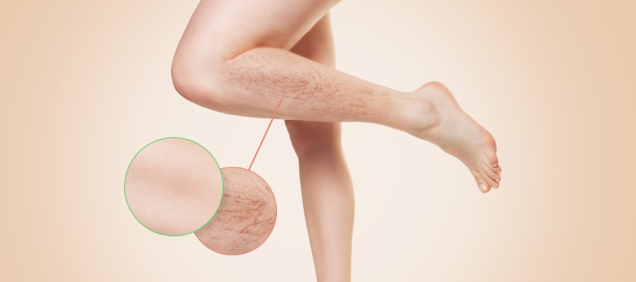 Can Vein Treatments Reduce Pain and Swelling in the Legs? | McKinney, TX Can Vein Treatments Reduce Pain and Swelling in the Legs? | McKinney, TX