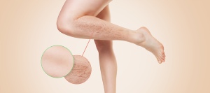 Can Vein Treatments Reduce Pain and Swelling in the Legs? | McKinney, TX Can Vein Treatments Reduce Pain and Swelling in the Legs? | McKinney, TX