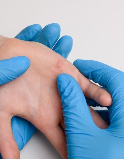 Wart Treatment & Removal at Preferred Dermatology